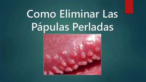 papulas perleadas|Pápulas perladas